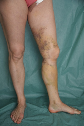 Tratament cu frunze de varza pentru varice - Venele mărite la picioare